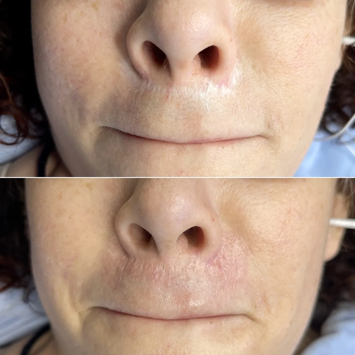 Nose and Lip Treatment Before and After