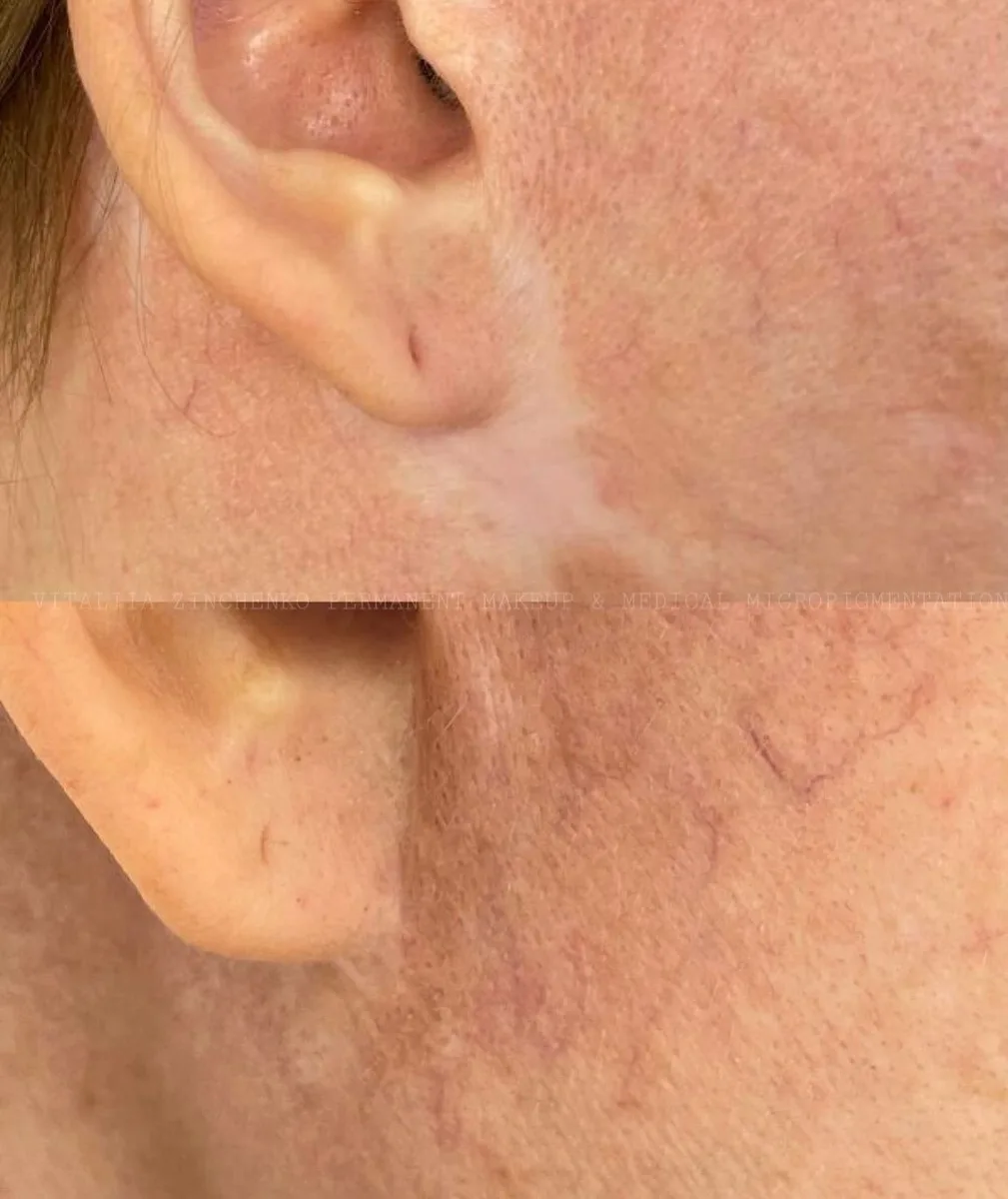 Medical Micropigmentation Before and After