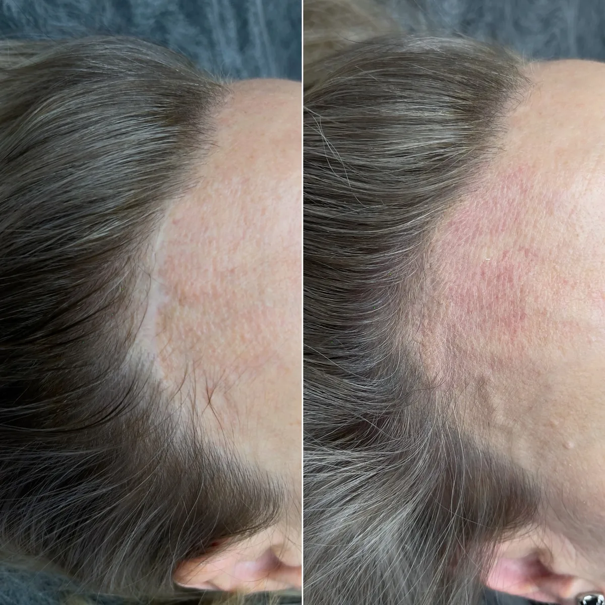 Skin Treatment Before and After