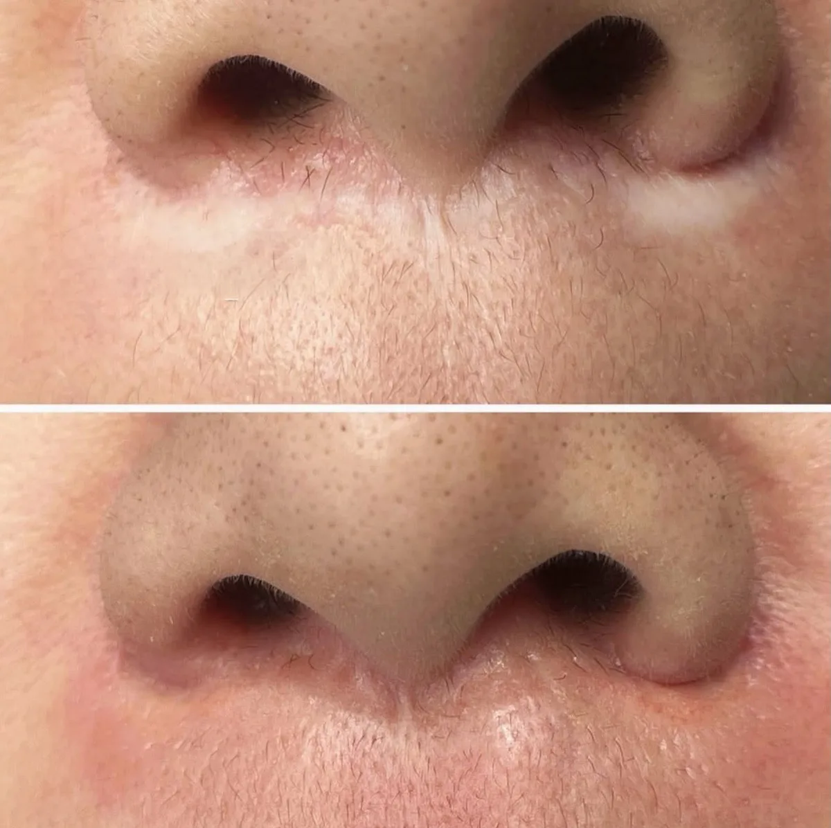 Nose Area Treatment Before and After