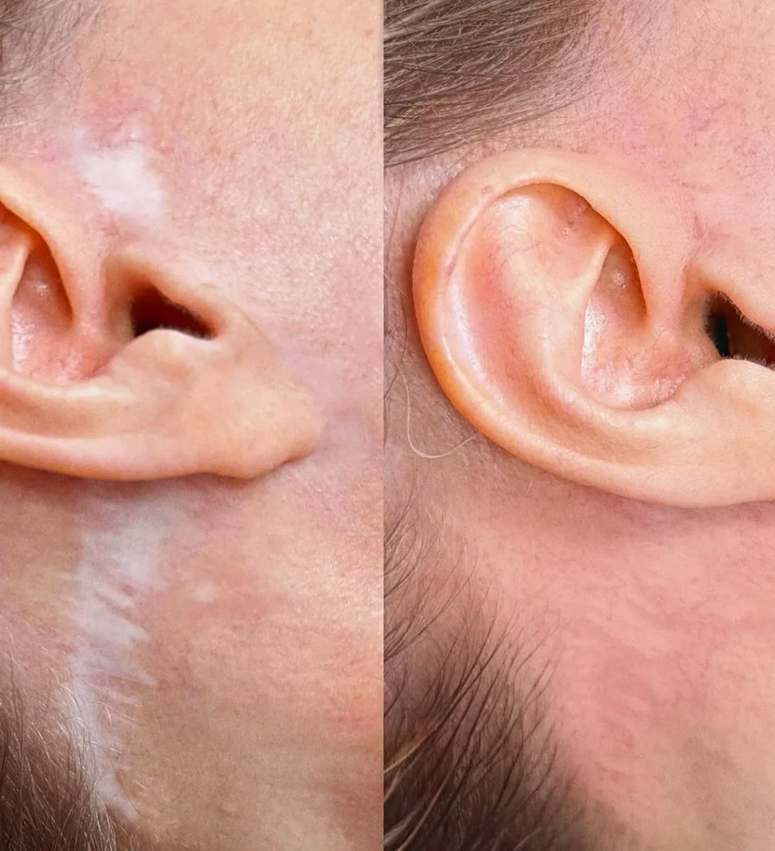 Vitiligo Treatment Before and After