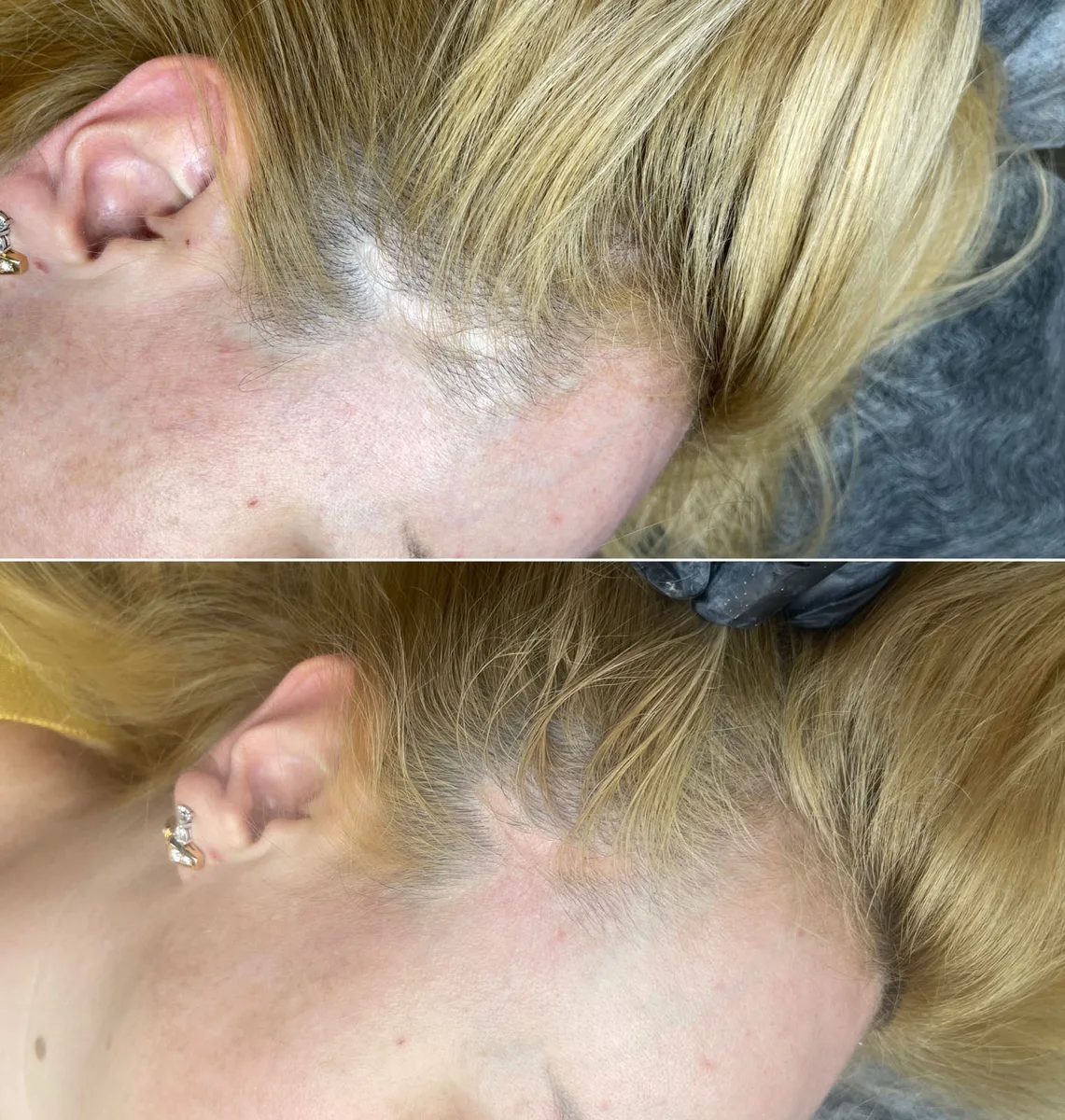 Hair Restoration Before and After