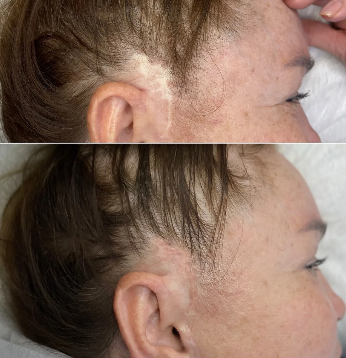 Skin Treatment Before and After